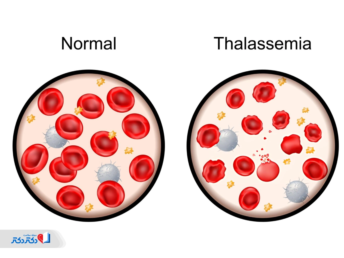 تالاسمی چیست