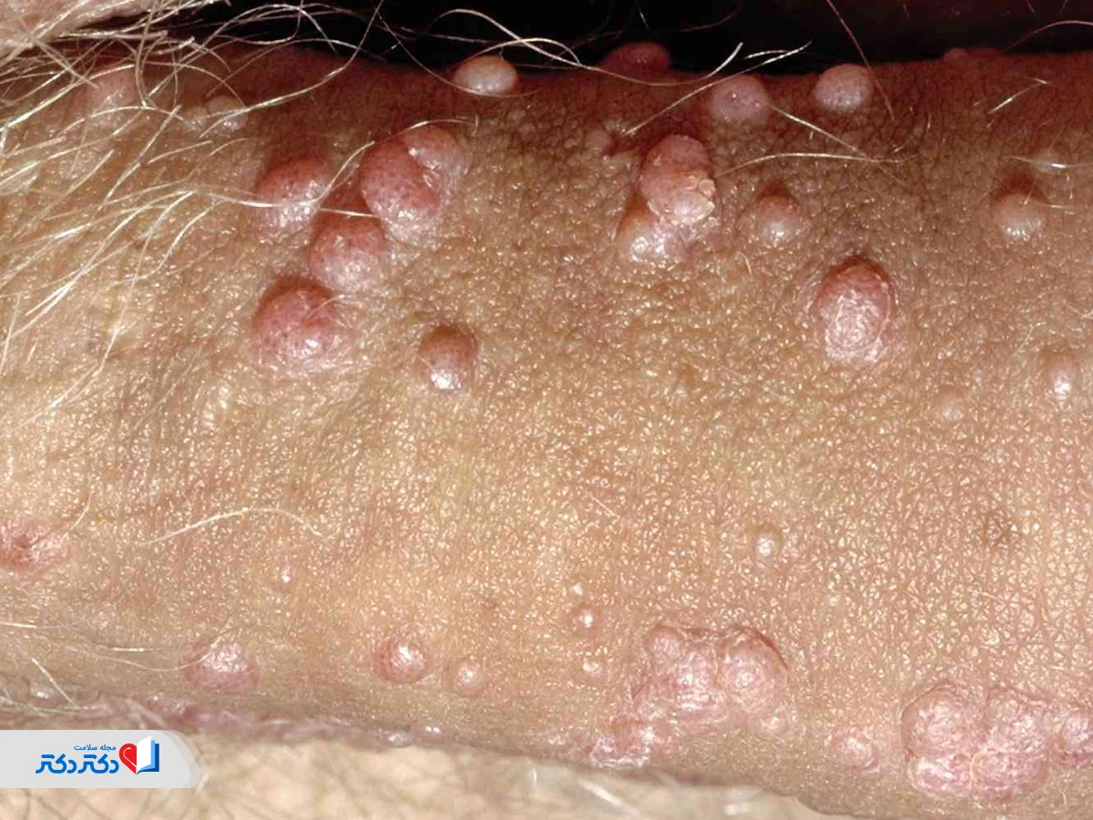 زگیل تناسلی روی آلت تناسلی