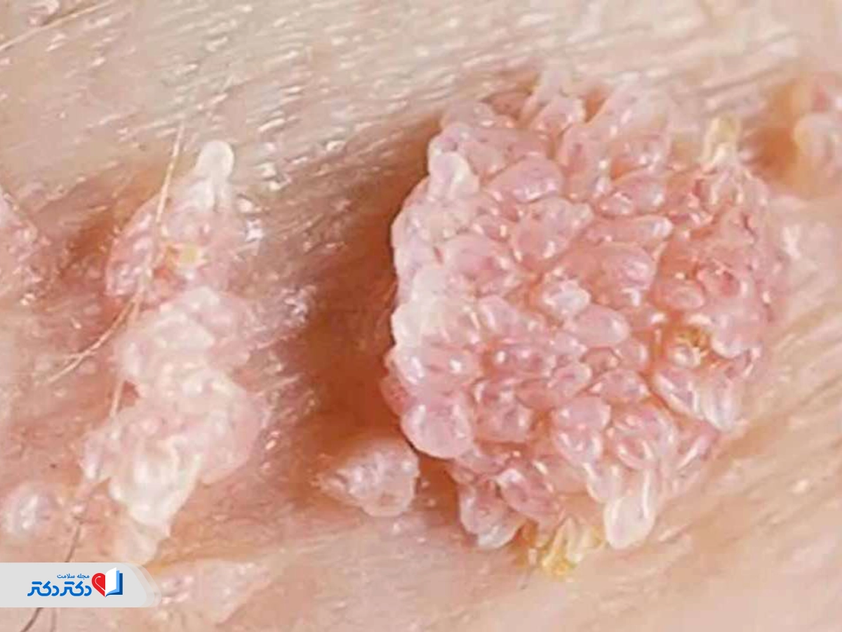 زگیلهای گلکلمی