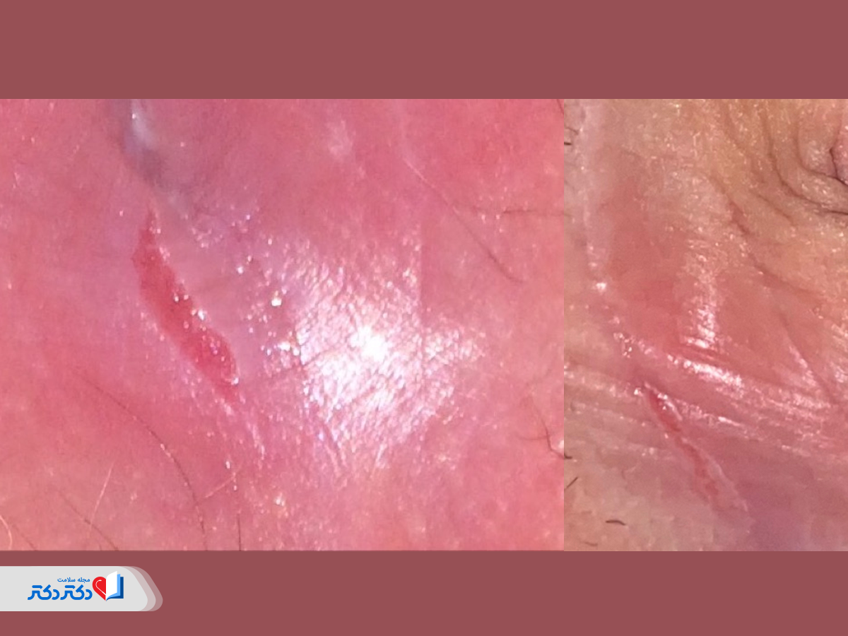 عکس شقاق واژینال