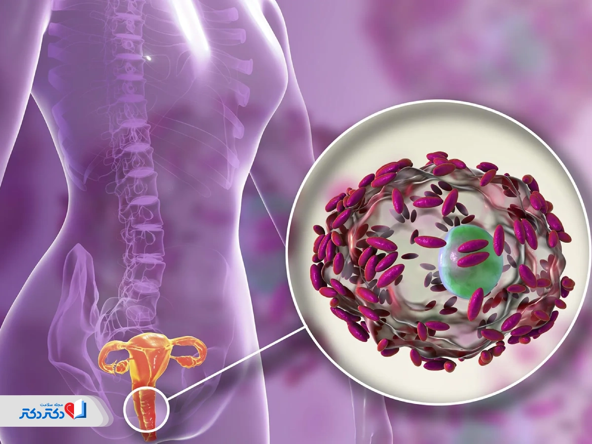 پماد خارش واژن برای عفونت‌های مقاربتی