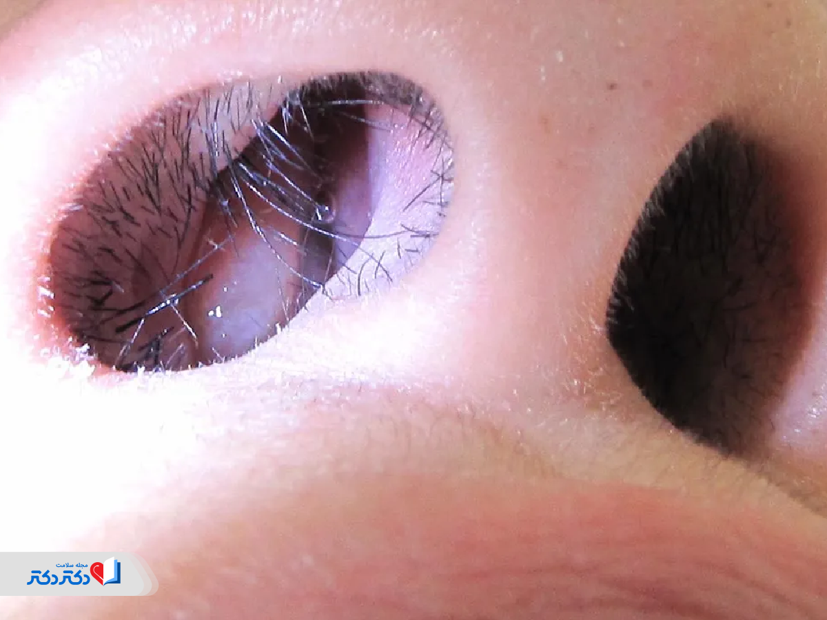 سی تی اسکن بینی برای چه مواردی انجام می‌شود؟
