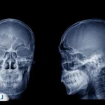 چرا برای جراحی بینی سی تی اسکن لازم است؟ تفسیر نتایج