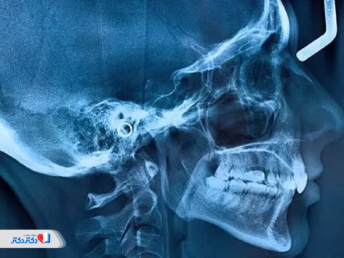 سی تی اسکن بینی با تزریق و بدون تزریق