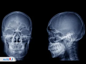 چرا برای جراحی بینی سی تی اسکن لازم است؟ تفسیر نتایج