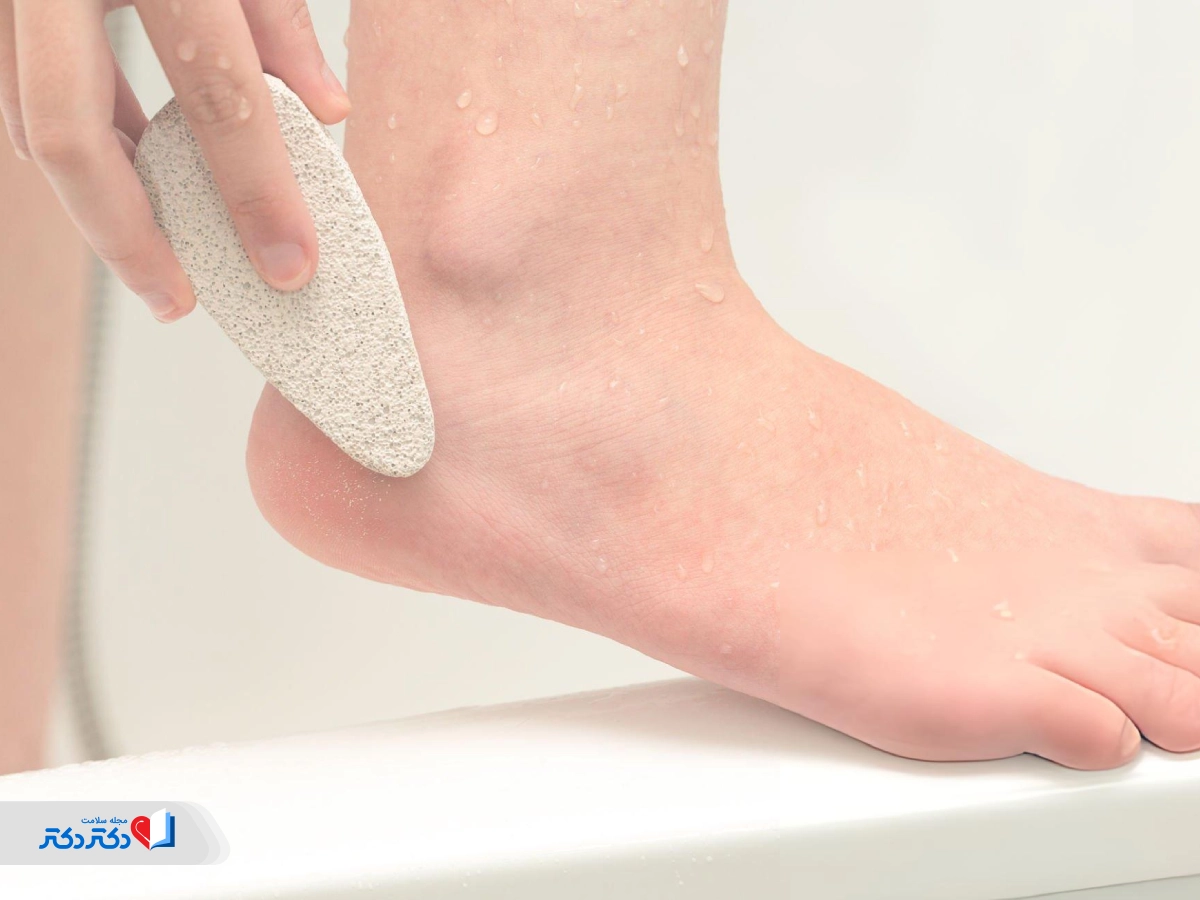 کاهش احتمال زخم پای دیابتی با استفاده از سنگ پا در حمام