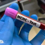 پایین بودن MCHC در آزمایش خون نشانه چیست؟ بررسی علت و درمان