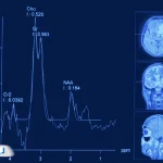 ام آر اس مغز چیست و چه تفاوتی با MRI معمولی دارد؟