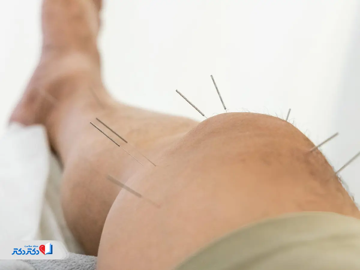 طب سوزنی برای مدیریت درد فیبرومیالژیا
