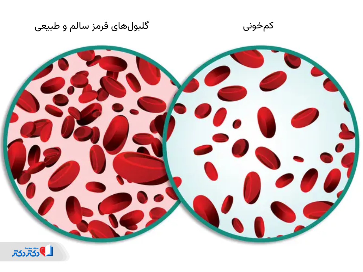 کم خونی چیست؟