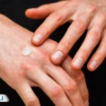 پماد فلوئوسینولون چیست و برای چه مواردی استفاده می‌شود؟