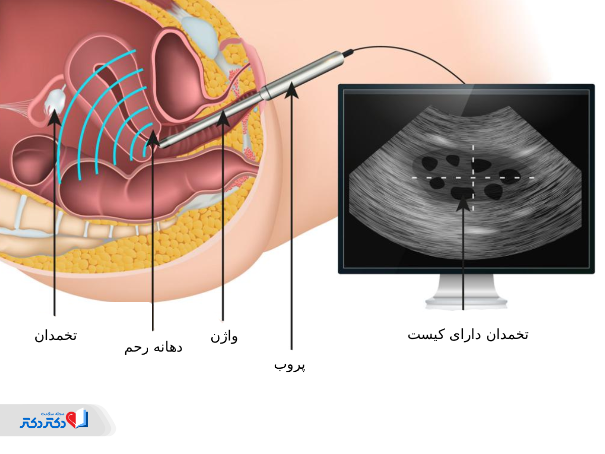 نحوه انجام سونوگرافی واژینال رحم و تخمدان