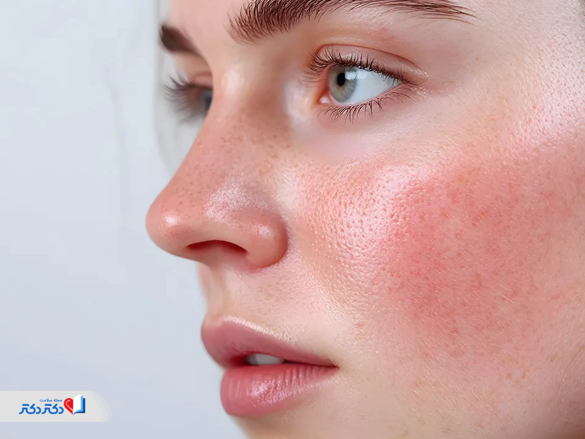 قرمزی پوست بعداز سولار و آفتاب دراثر اشعه UV