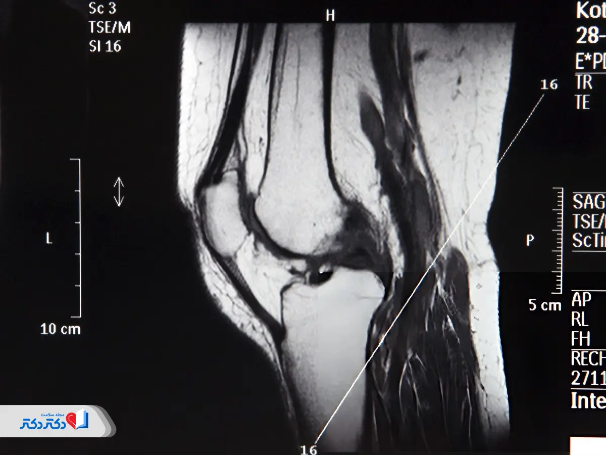 نمونه جواب mri زانو