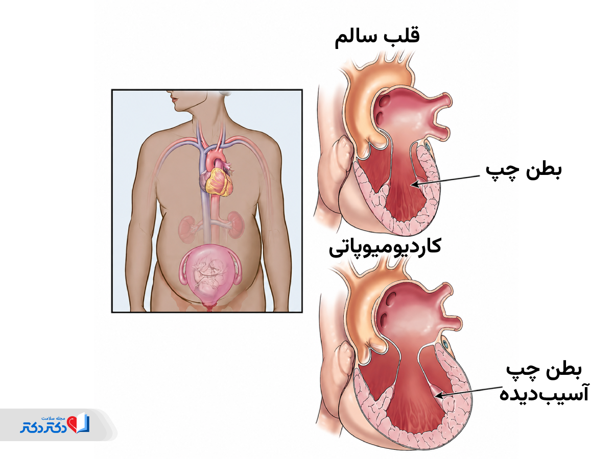 کاردیومیوپاتی پریپارتوم چیست؟