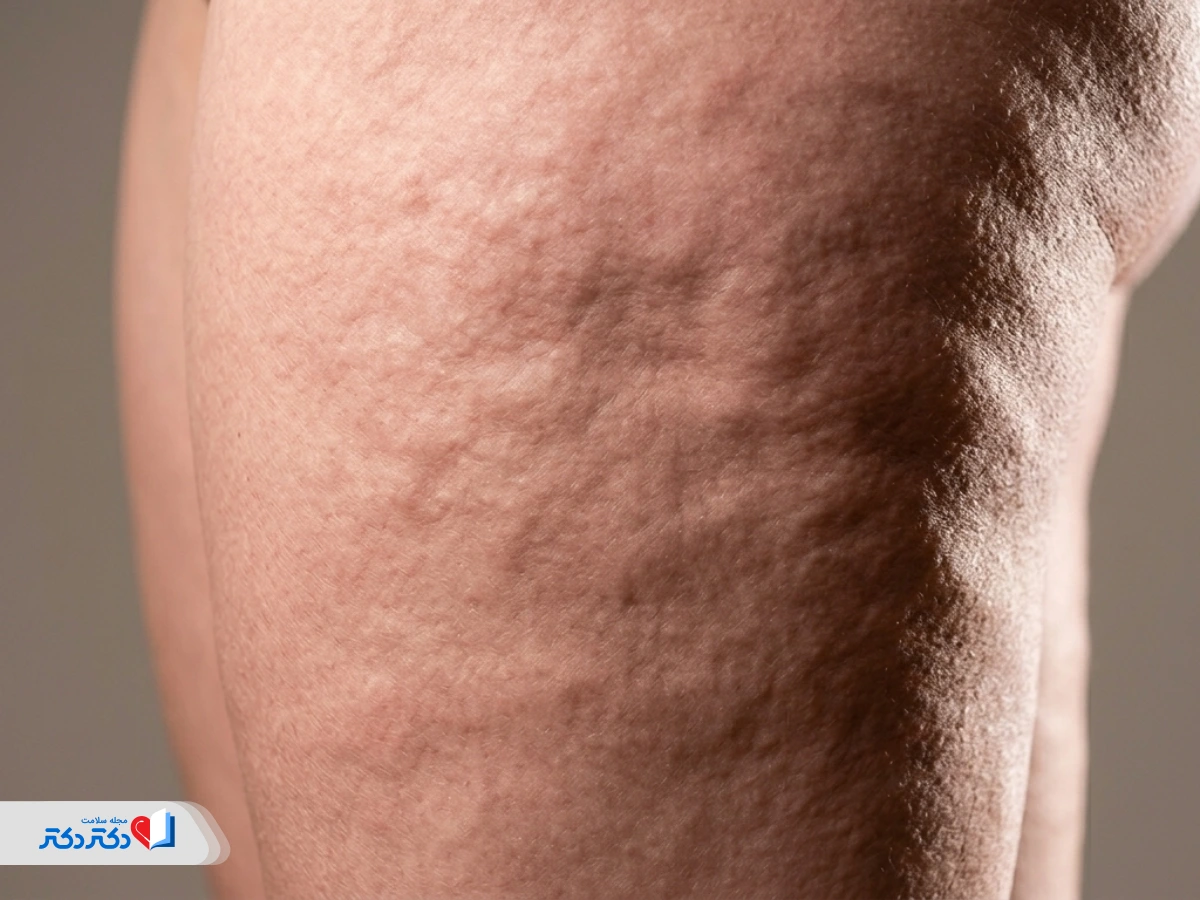 کاربردهای کرم آنتی سلولیت سینره