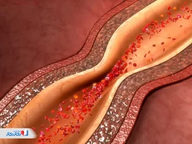 اسپاسم عروق کرونری چیست؟ علائم، علت، تشخیص و درمان اسپاسم قلبی