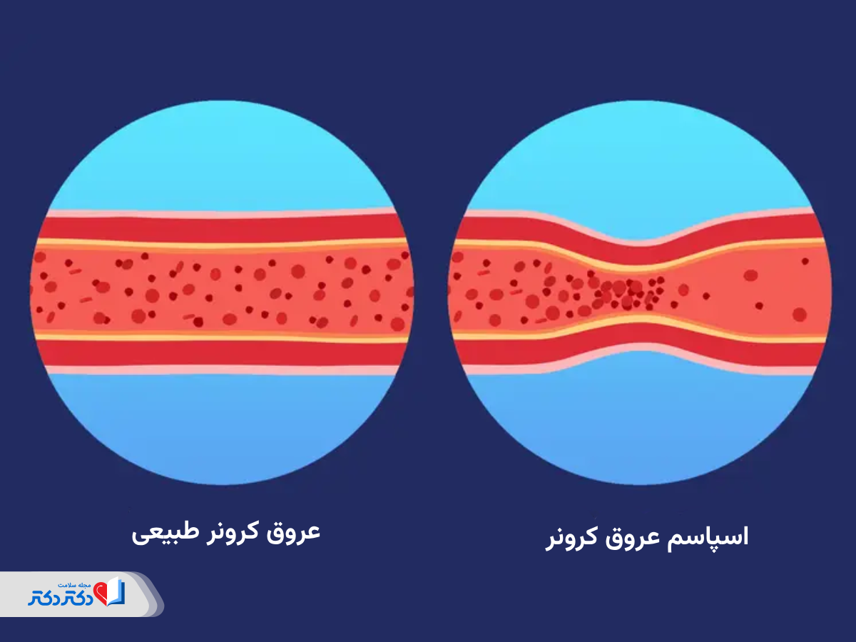 اسپاسم عروق کرونری چگونه جریان خون را مختل میکند؟