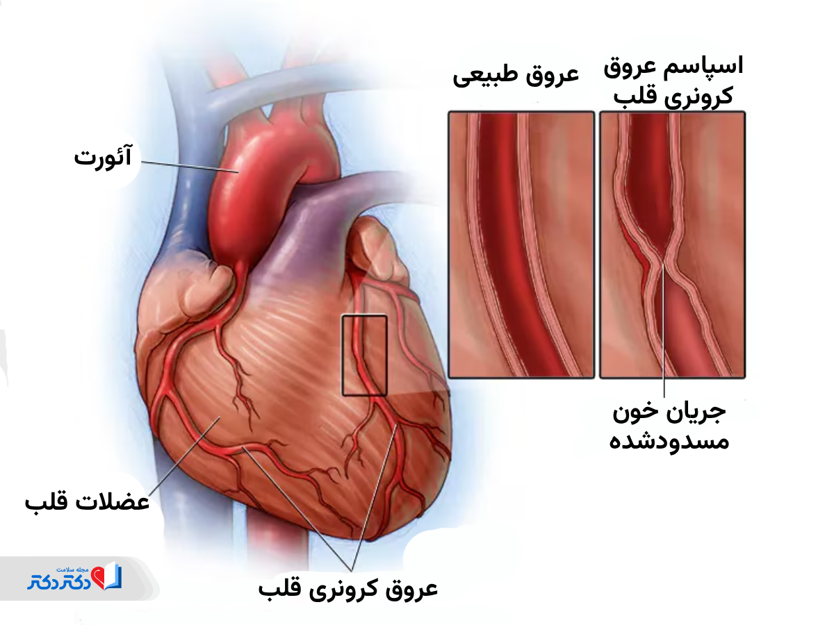 اسپاسم عروق کرونری چیست؟