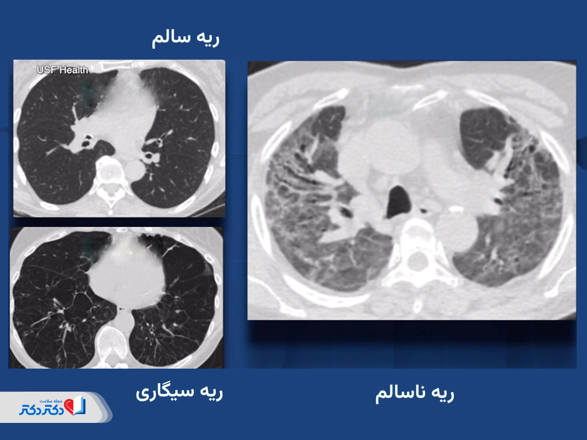 عکس ریه سالم و ناسالم در سی تی اسکن