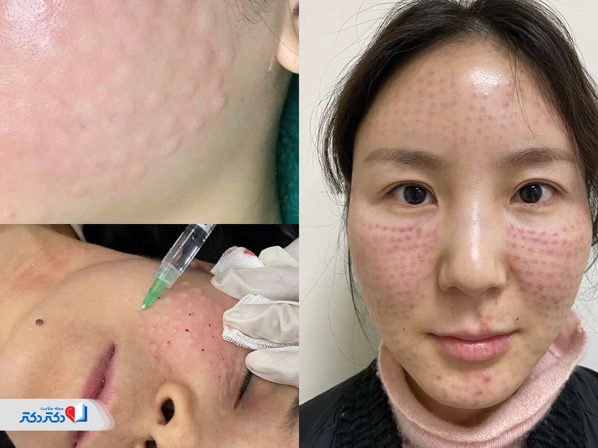 عوارض کوکتل فیوژن و نکات مهم قبل از تزریق