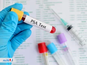آزمایش پروستات (PSA) چیست؟ تفسیر نتایج و زمان انجام این آزمایش