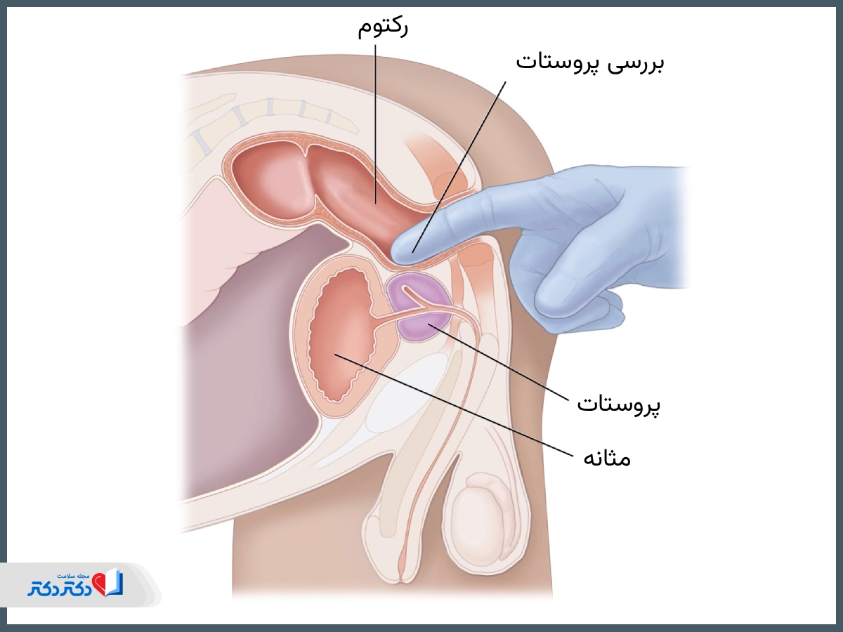 آزمایش پروستات از طریق رکتوم