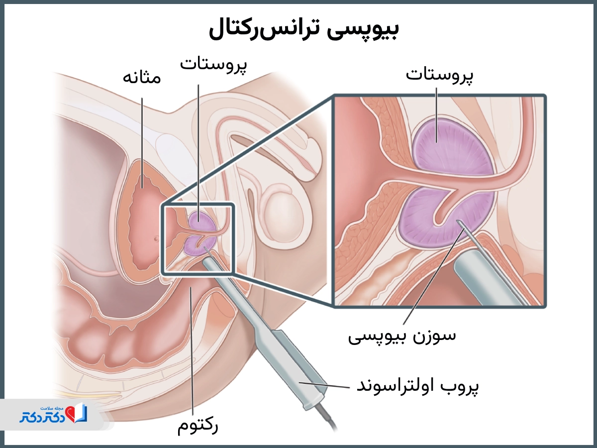 بیوپسی ترانس رکتال