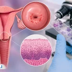 CIN 1 چیست؟ علائم، درمان و احتمال بهبودی کامل