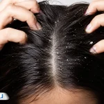 علت شوره سر چیست و چگونه آن را درمان کنیم؟ راهنمای کامل رفع شوره