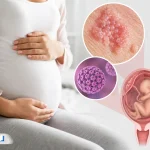 زگیل تناسلی در بارداری؛ علائم، عوارض، روش‌های درمان و تأثیر بر زایمان