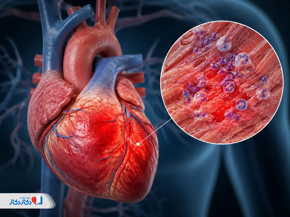 بیماری میوکاردیت؛ هر آنچه باید درباره التهاب عضله قلب بدانید