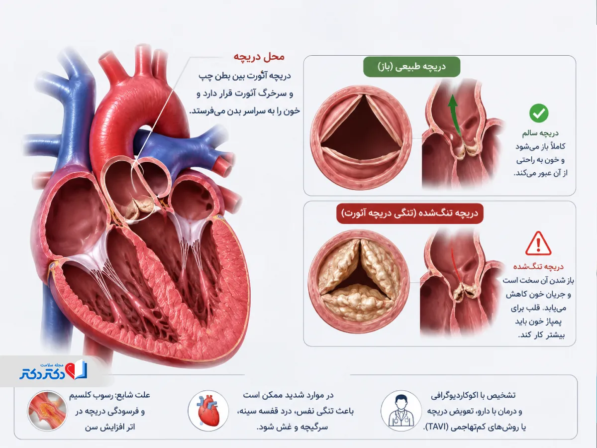 توضیح تنگی دریچه آئورت