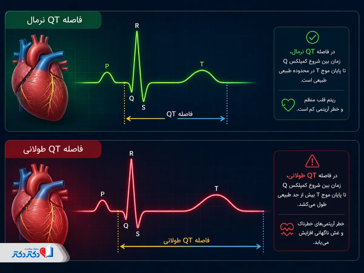 فاصله نرمال qt در نوار قلب در برابر سندرم QT طولانی قلب