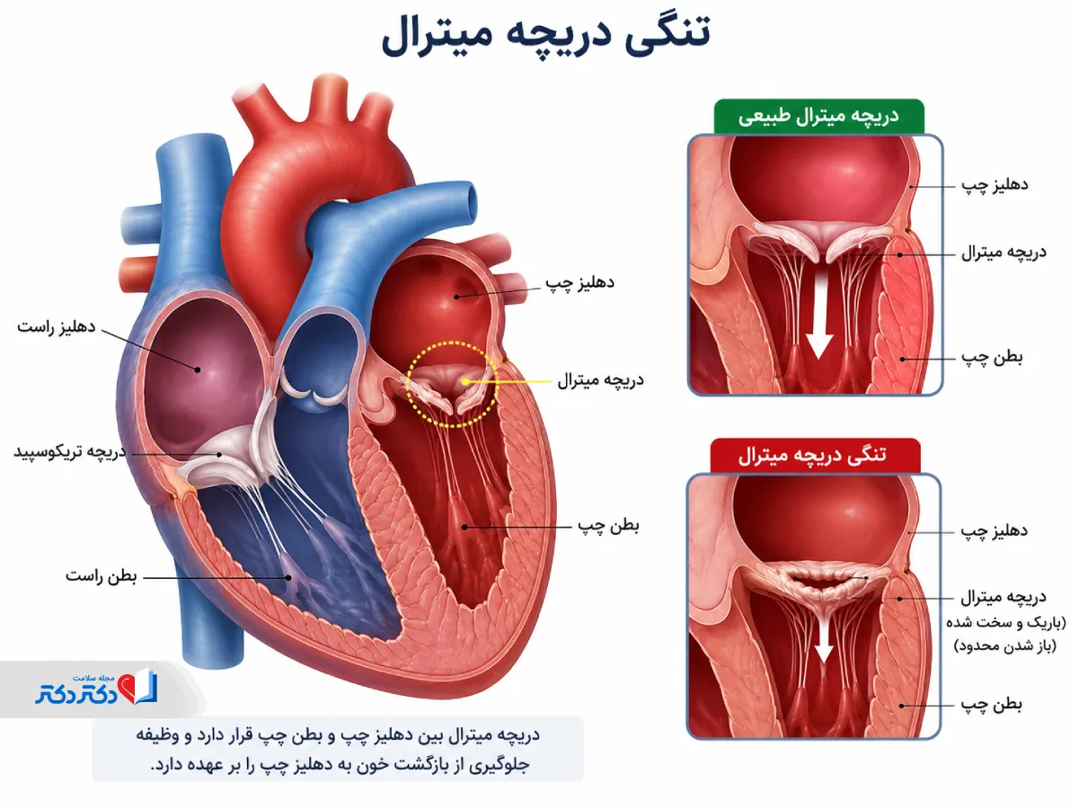 تنگی دریچه میترال