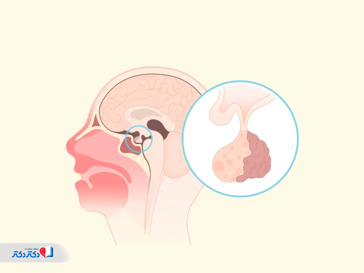 علائم تومور هیپوفیز چیست ؟