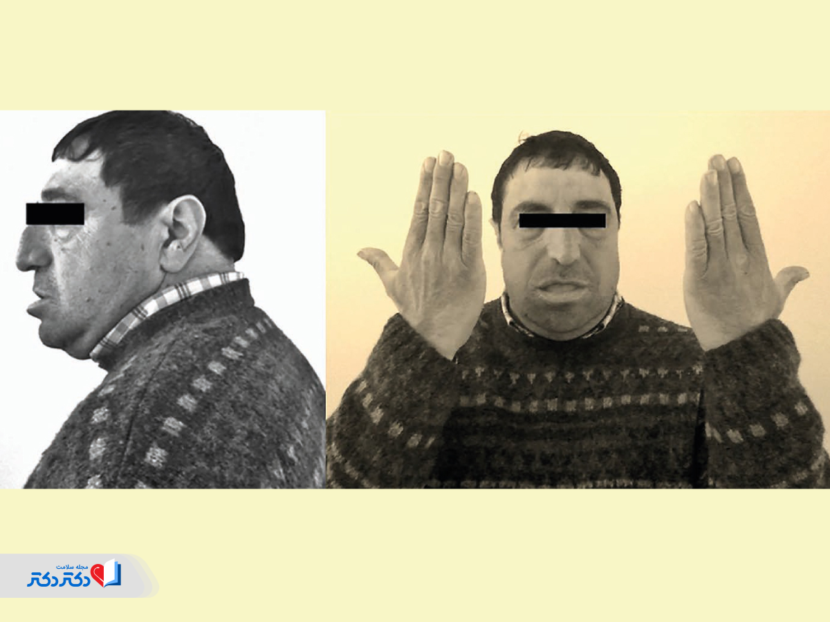 عوارض آکرومگالی