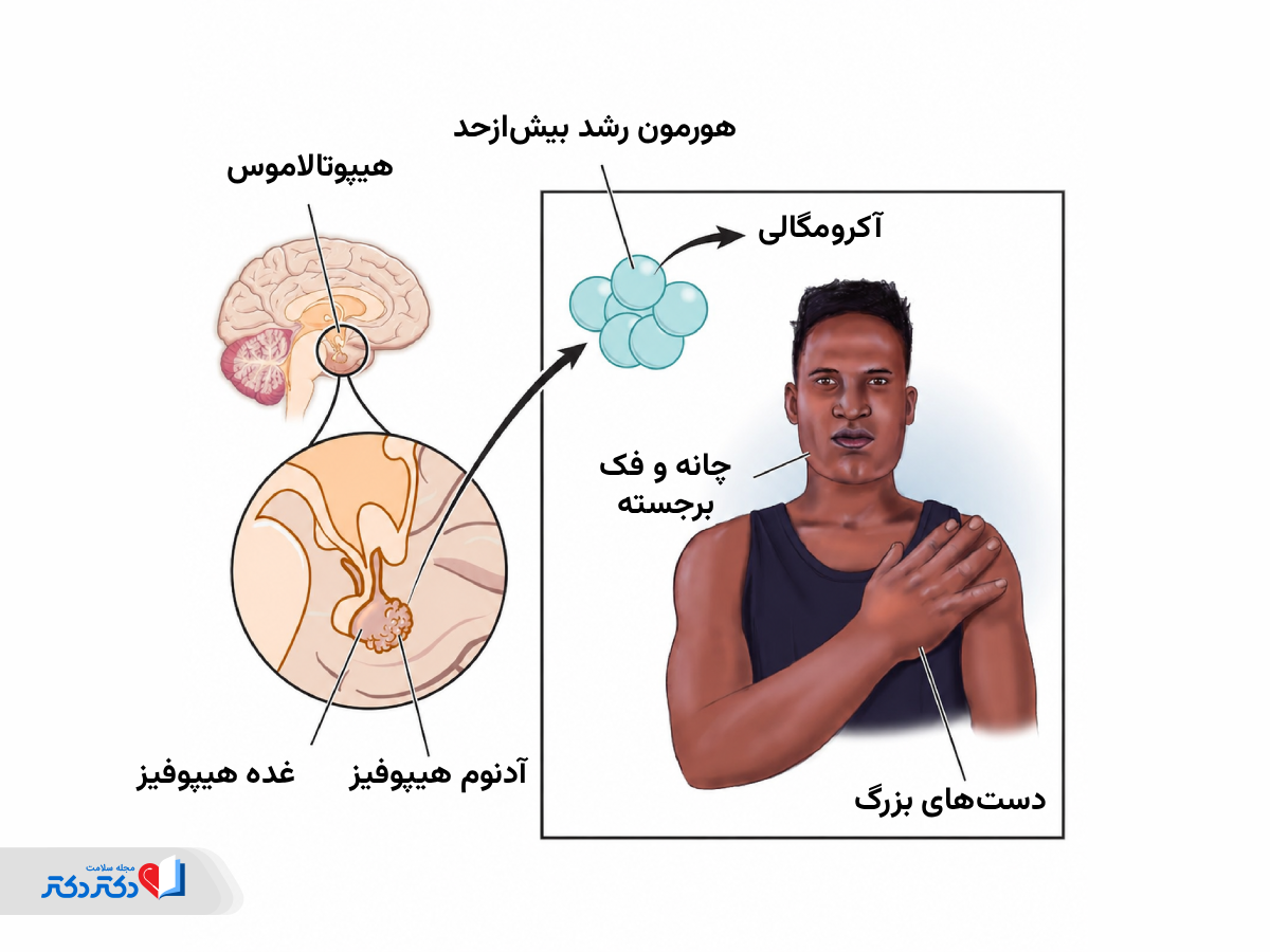 علت آکرومگالی چیست؟