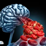 هرآنچه باید درباره آمبولی مغزی بدانید؛ علائم، علت‌ها و درمان