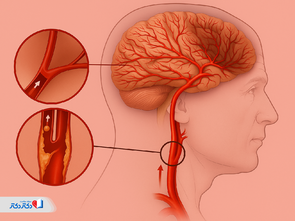 علت آمبولی مغزی چیست؟
