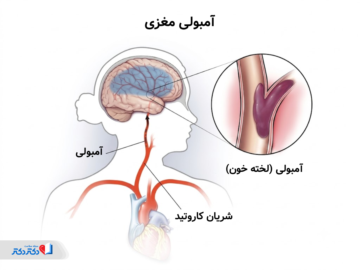 آمبولی مغزی چیست؟