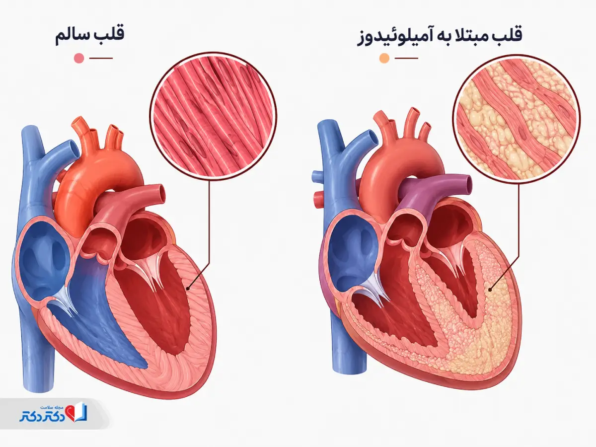 انواع آمیلوئیدوز قلبی
