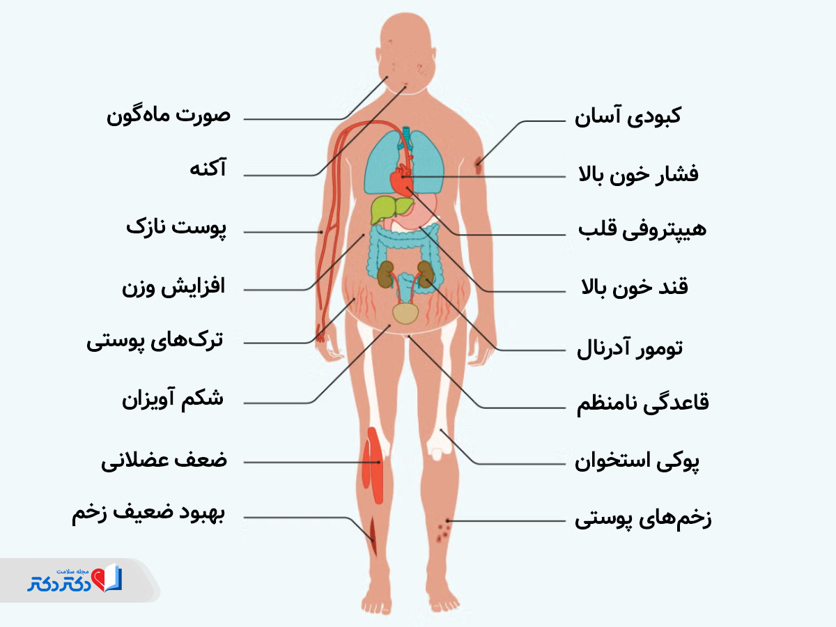 علائم سندرم کوشینگ