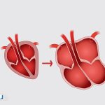 کاردیومیوپاتی دیلاته (DCM)؛ علائم خطرناک و روش‌های درمان موثر