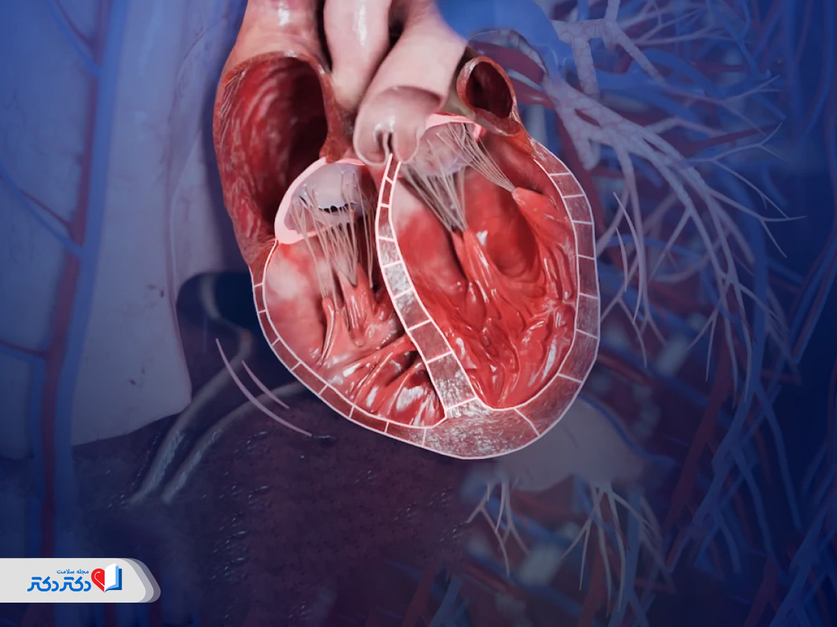 پیشگیری از کاردیومیوپاتی دیلاته