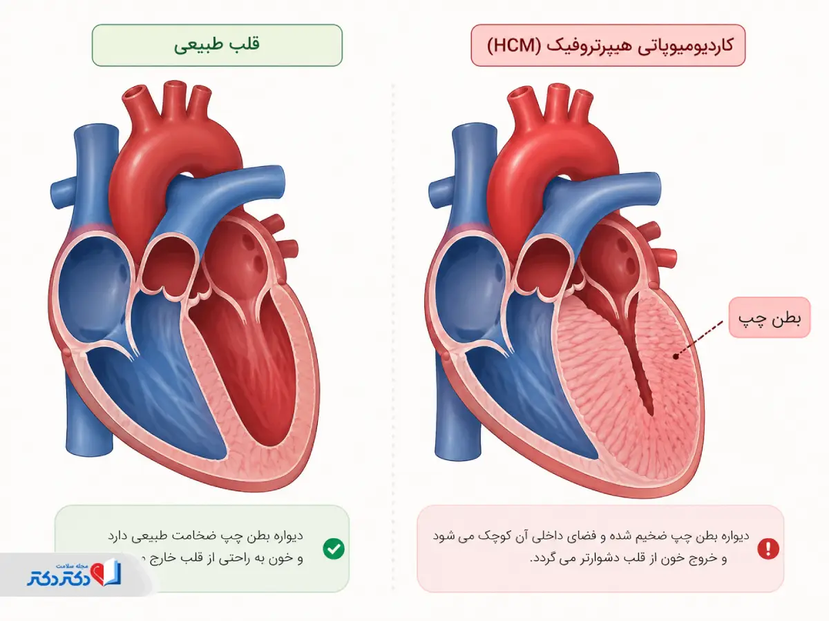 تفاوت قلب درگیر کاردیومیوپاتی هیپرتروفیک با قلب معمولی