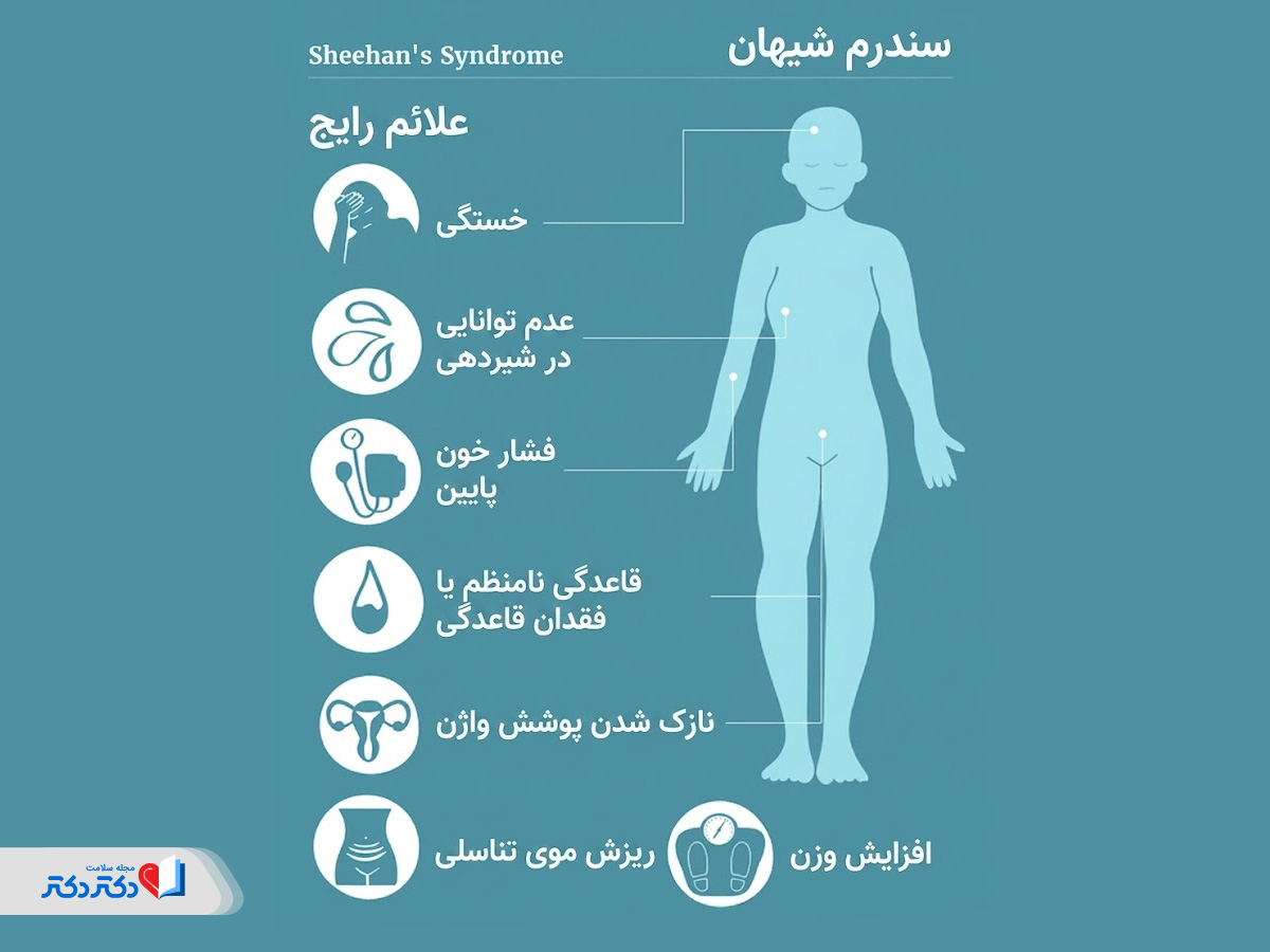 کمکاری غده هیپوفیز در زنان