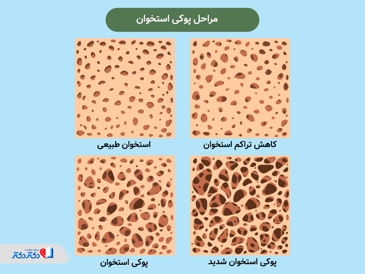 انواع پوکی استخوان