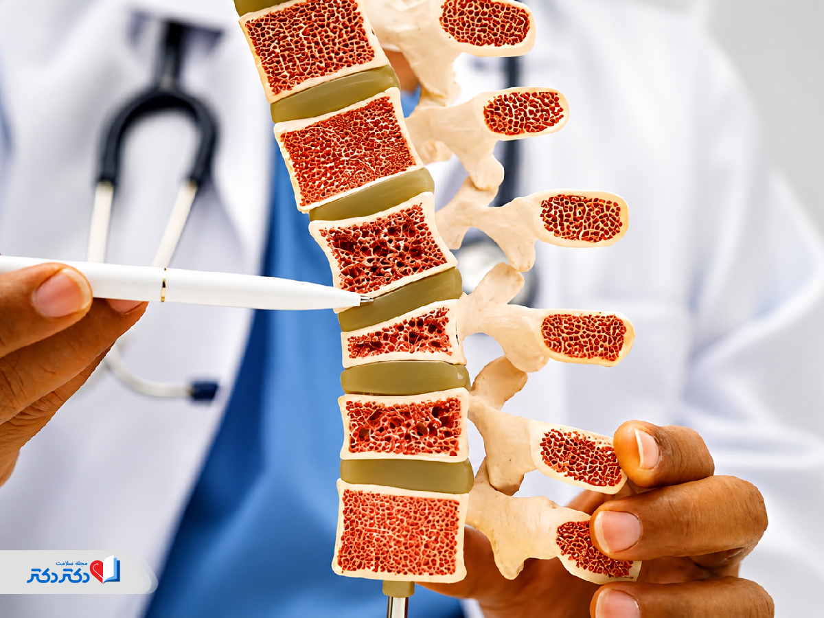 پوکی استخوان چیست؟ از علائم و تشخیص تا درمان دارویی و تغذیهای