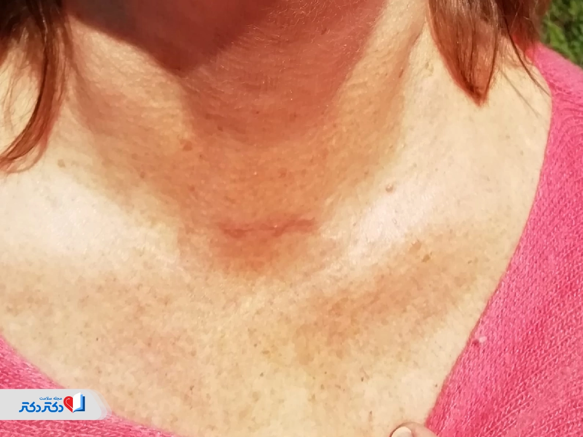 جای زخم جراحی بعد از برداشتن غده پاراتیروئید